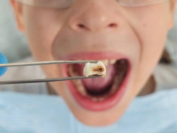 Best Emergency Dental Care for Sports Injuries in Monticello, IN